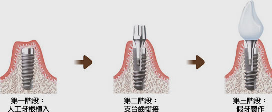 什麼是人工植牙